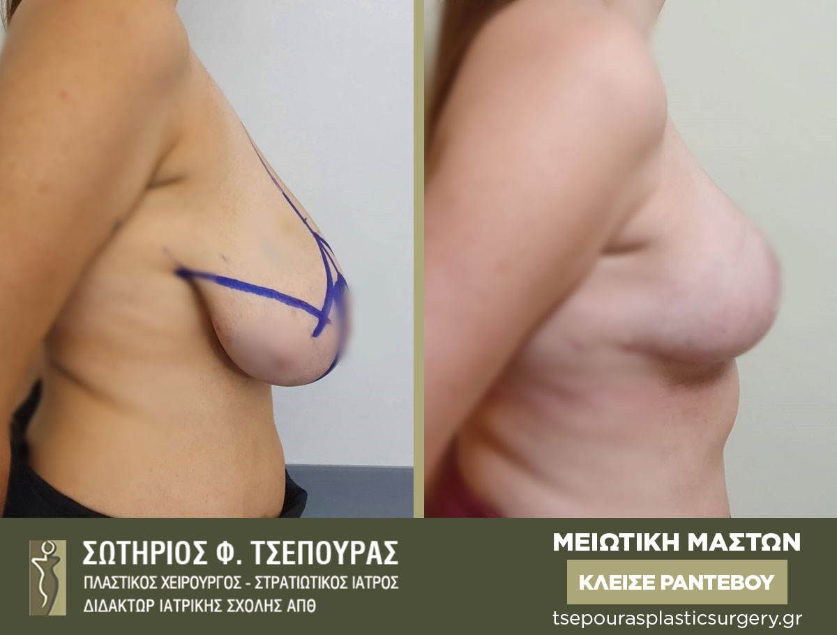 Μειωτική Στήθους Mειωτική Μαστών Θεσσαλονίκη Μεγαλομαστία