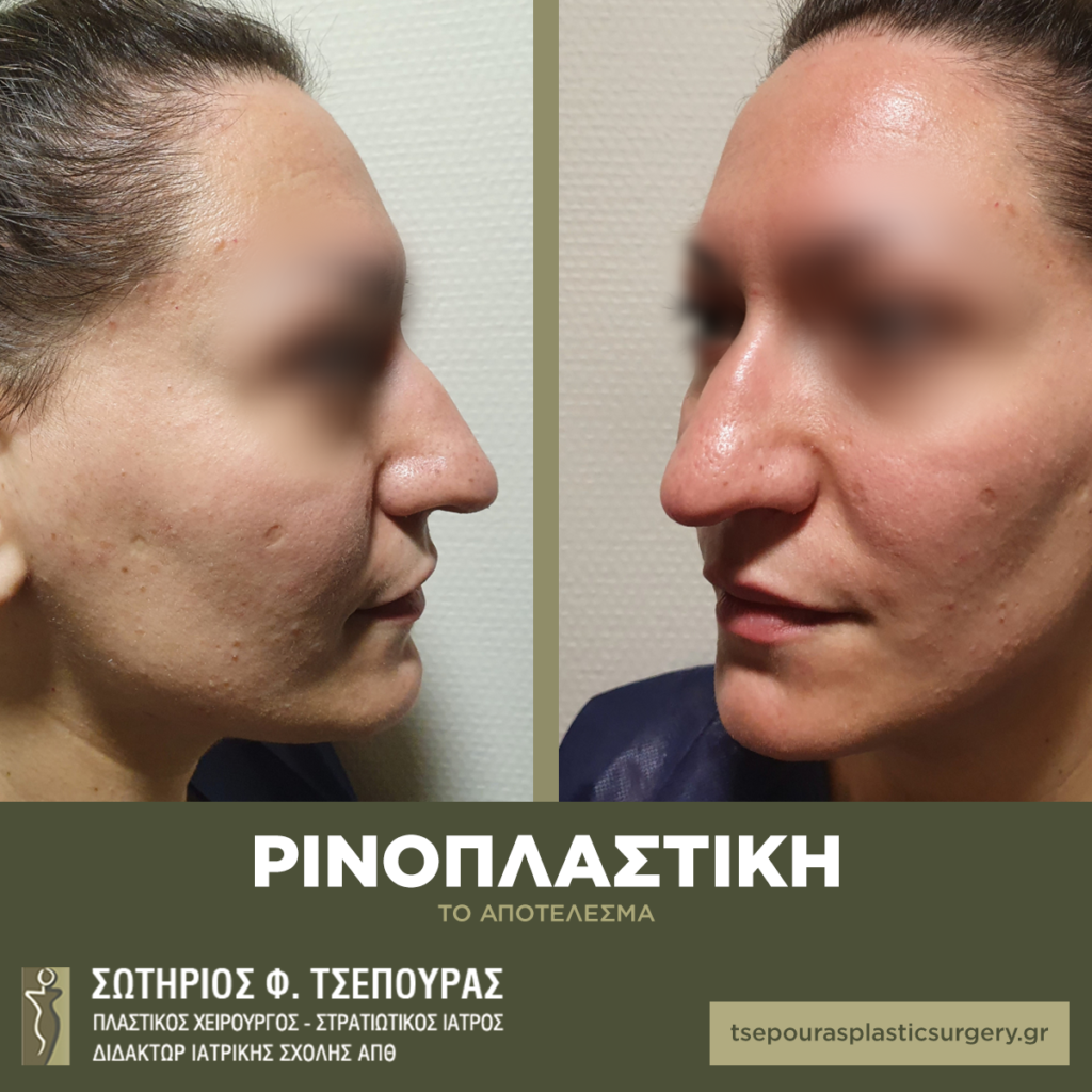 Ρινοπλαστική σε κοπέλα στη Θεσσαλονίκη πριν και 2 εβδομάδες μετά την επέμβαση