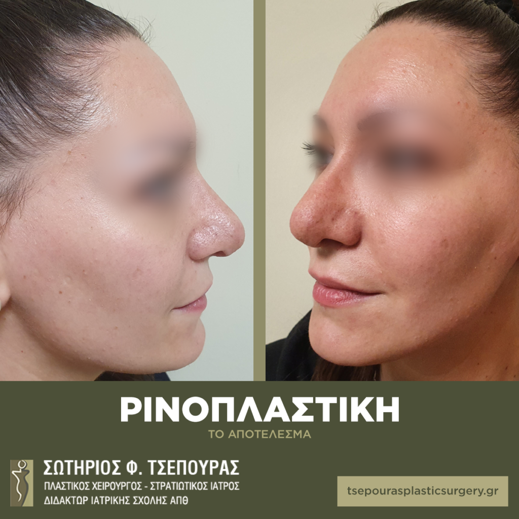 Ρινοπλαστική σε κοπέλα στη Θεσσαλονίκη πριν και 2 εβδομάδες μετά την επέμβαση