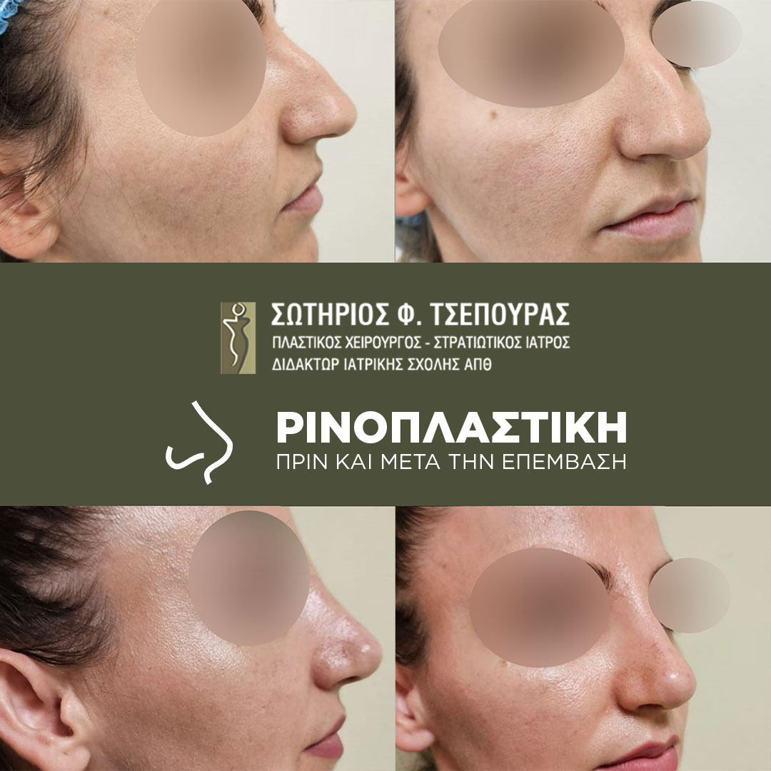 ΡΙΝΟΠΛΑΣΤΙΚΗ σε Kοπέλα πριν και 1 Μήνα μετά την Eπέμβαση. Η Εφαρμογή της Ενδεδειγμένης Χειρουργικής Τεχνικής και ο Σωστός Προεγχειρητικός Σχεδιασμός Διασφαλίζουν το Καλύτερο Αισθητικό Αποτέλεσμα. Το Αποτέλεσμα είναι Άμεσα Ορατό Ωστόσο Απαιτούνται 3-6 μήνες για την Τελική Διαμόρφωση του.